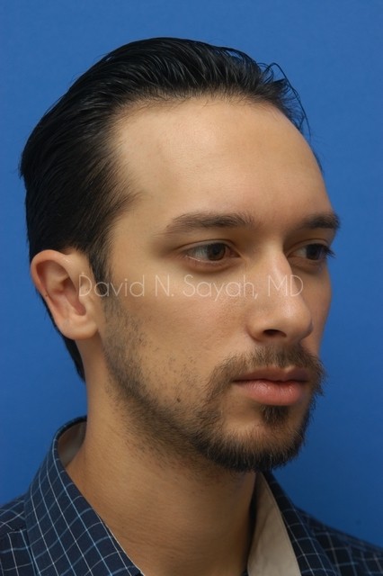 Ear Surgery Before and After | Sayah Institute