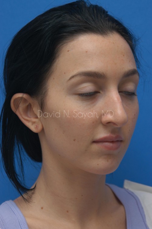 Ear Surgery Before and After | Sayah Institute