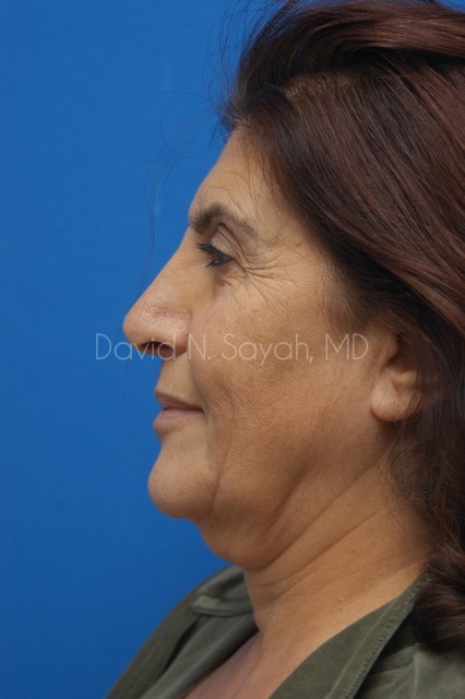 Endoscopic Brow Lift Before and After | Sayah Institute