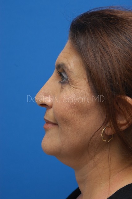 Endoscopic Brow Lift Before and After | Sayah Institute