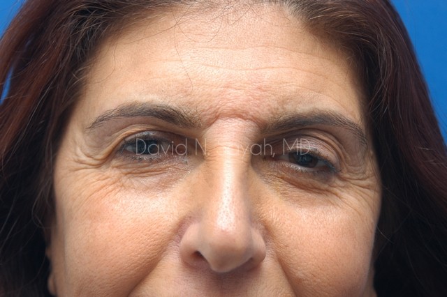 Endoscopic Brow Lift Before and After | Sayah Institute