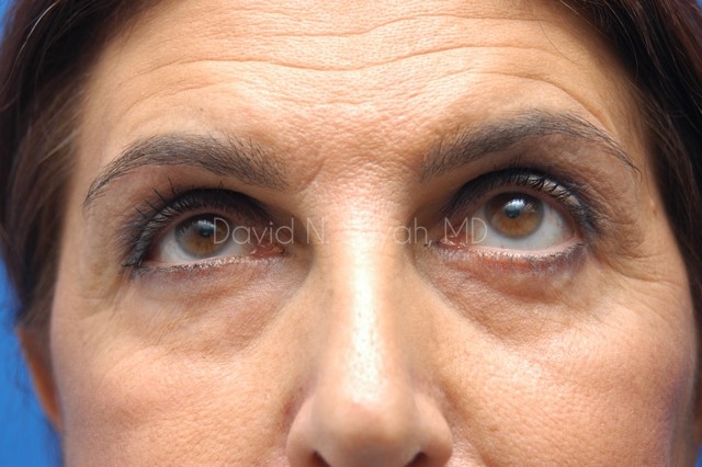 Endoscopic Brow Lift Before and After | Sayah Institute