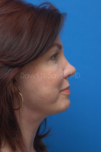 Endoscopic Brow Lift Before and After | Sayah Institute