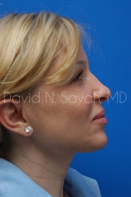 Endoscopic Brow Lift Before and After | Sayah Institute