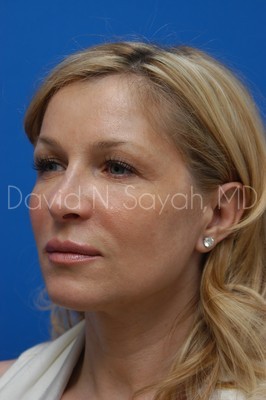 Endoscopic Brow Lift Before and After | Sayah Institute