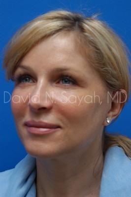 Endoscopic Brow Lift Before and After | Sayah Institute