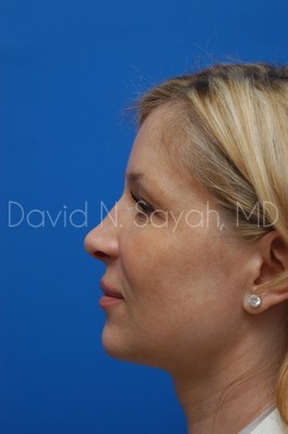 Endoscopic Brow Lift Before and After | Sayah Institute