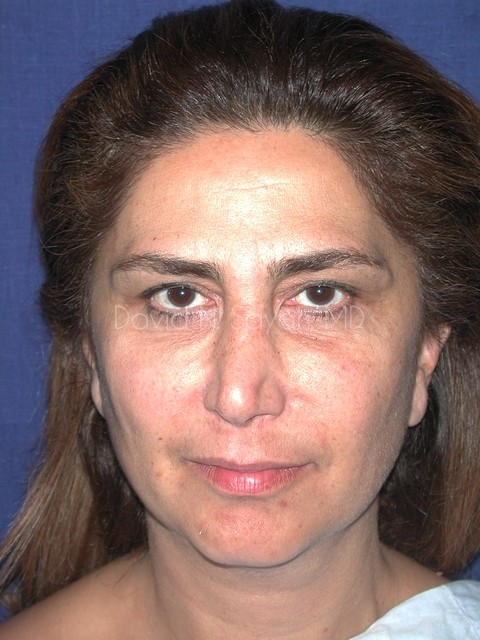 Endoscopic Brow Lift Before and After | Sayah Institute