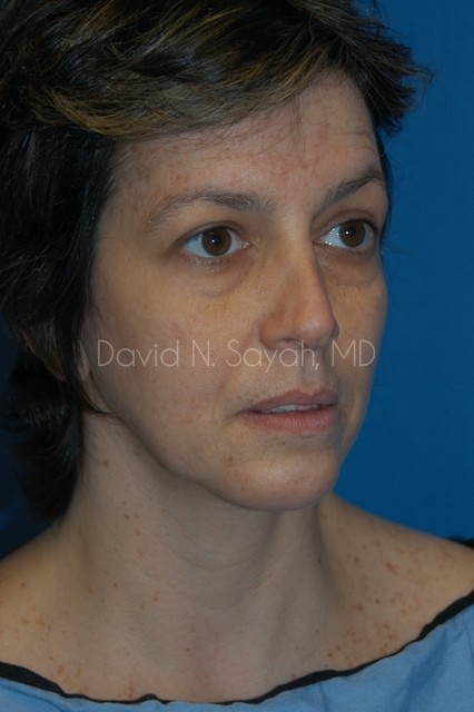 Endoscopic Facelift Before and After | Sayah Institute