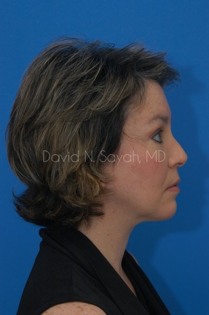 Endoscopic Facelift Before and After | Sayah Institute