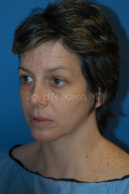 Endoscopic Facelift Before and After | Sayah Institute