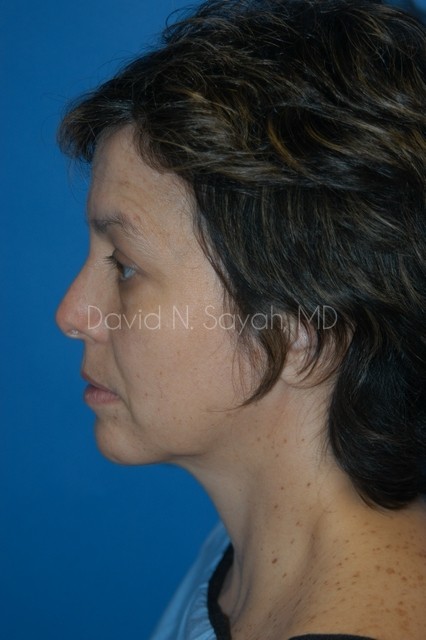 Endoscopic Facelift Before and After | Sayah Institute