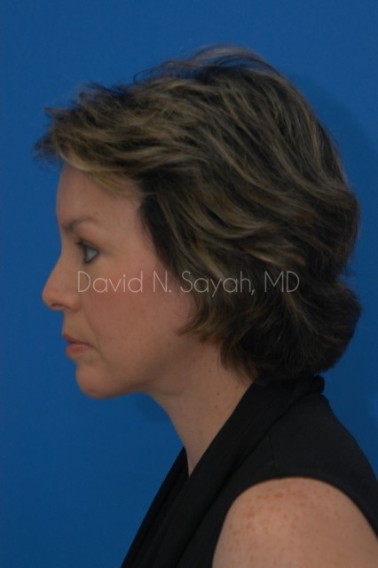 Endoscopic Facelift Before and After | Sayah Institute