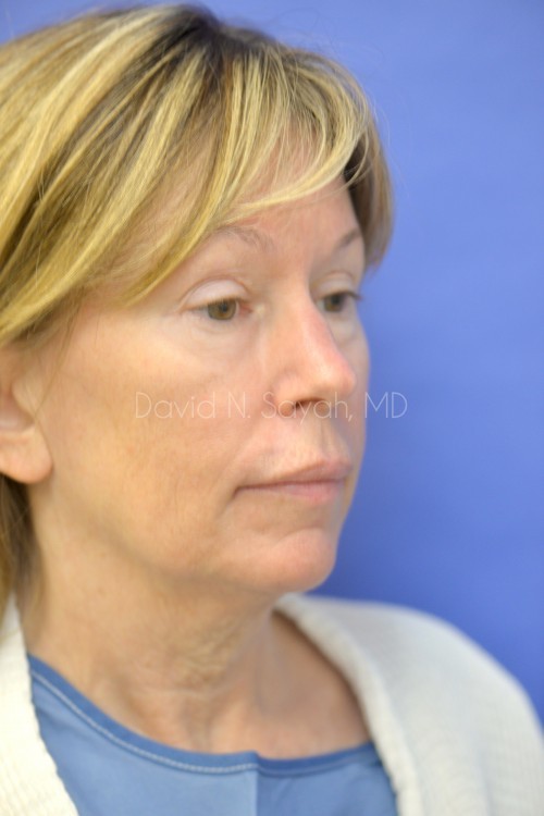 Eyelid Surgery Before and After | Sayah Institute