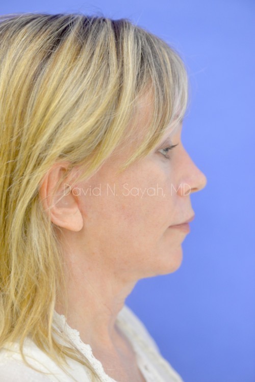 Eyelid Surgery Before and After | Sayah Institute