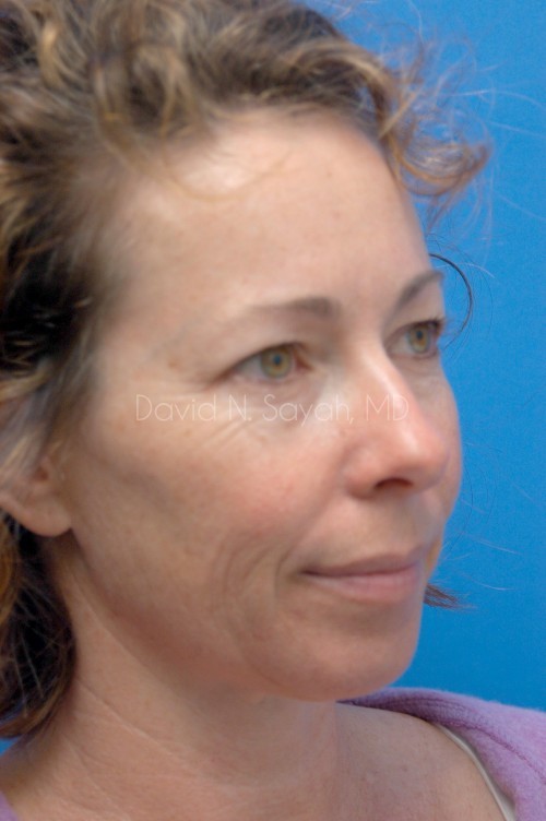 Eyelid Surgery Before and After | Sayah Institute