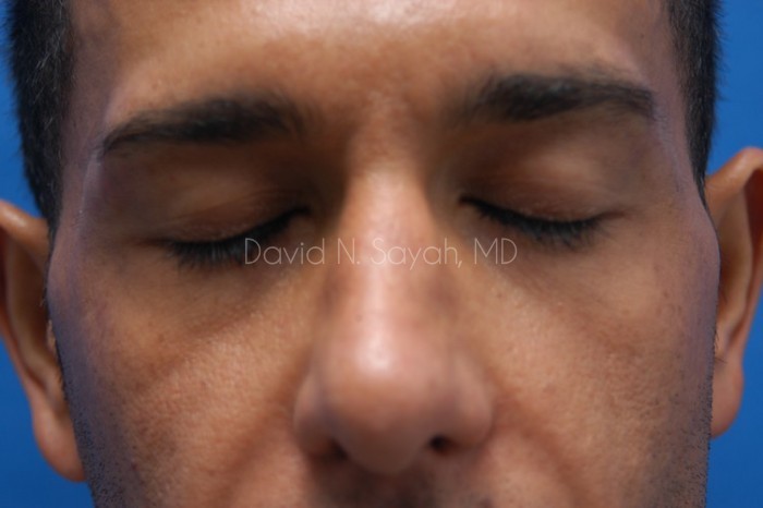 Eyelid Surgery Before and After | Sayah Institute