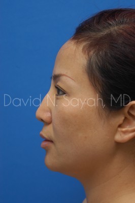 Eyelid Surgery Before and After | Sayah Institute