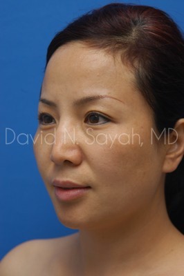 Eyelid Surgery Before and After | Sayah Institute