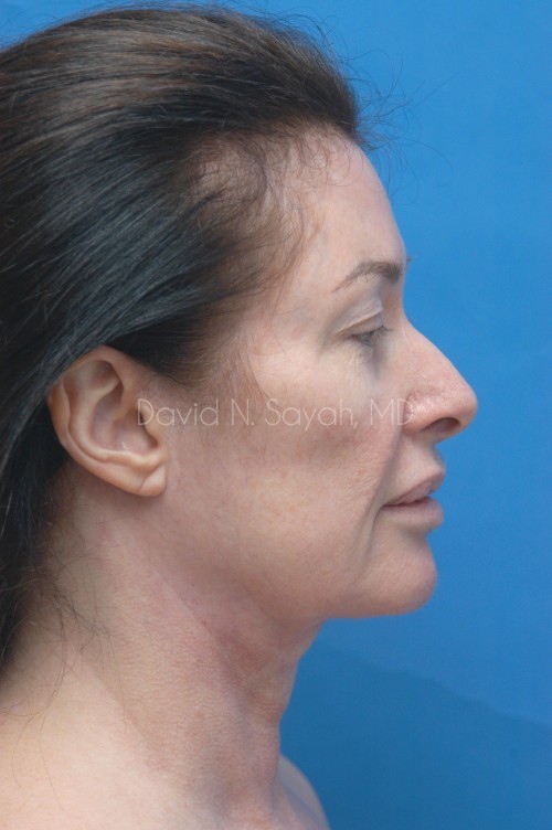 Facelift Before and After | Sayah Institute