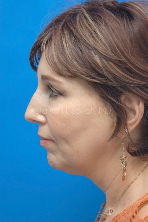 Facelift Before and After | Sayah Institute
