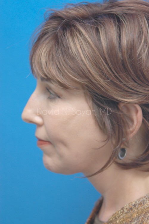 Facelift Before and After | Sayah Institute