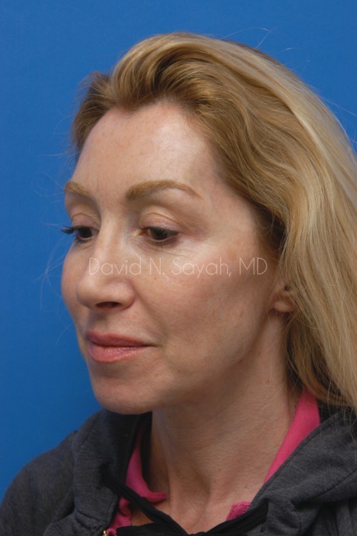 Facelift Before and After | Sayah Institute