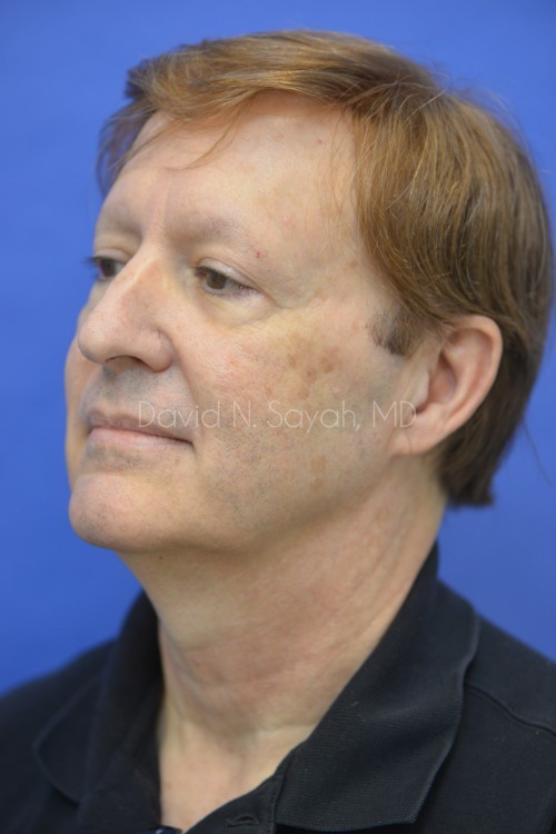 Facelift Before and After | Sayah Institute