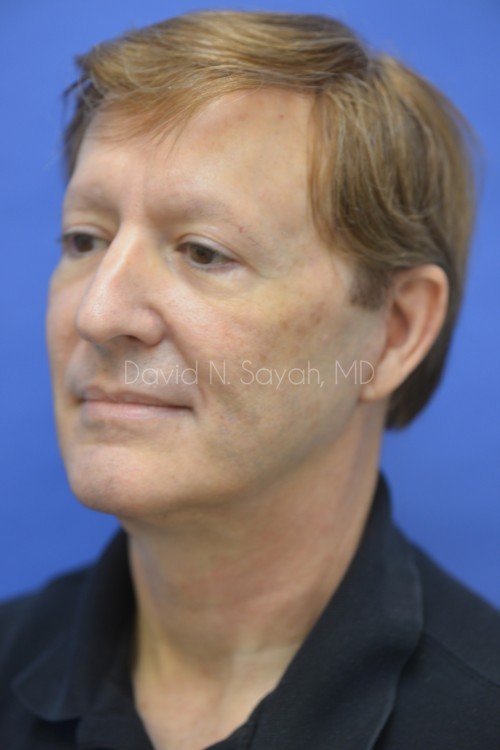 Facelift Before and After | Sayah Institute