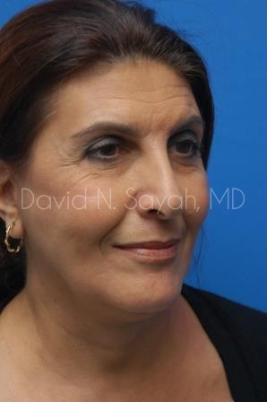 Facelift Before and After | Sayah Institute