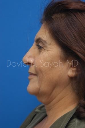 Facelift Before and After | Sayah Institute