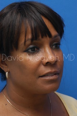 Facelift Before and After | Sayah Institute