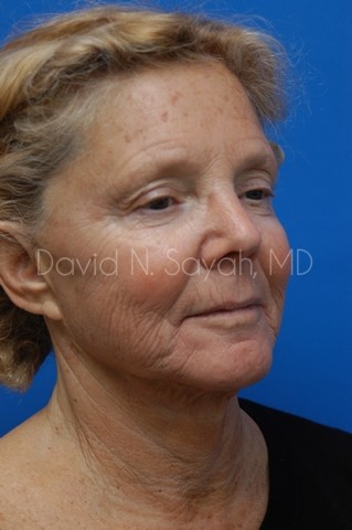 Facelift Before and After | Sayah Institute
