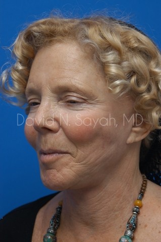 Facelift Before and After | Sayah Institute
