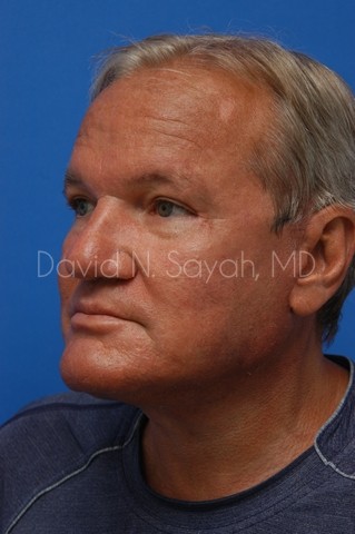 Facelift Before and After | Sayah Institute