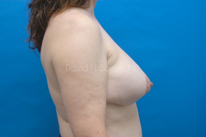 Fat Injection Breast Before and After | Sayah Institute