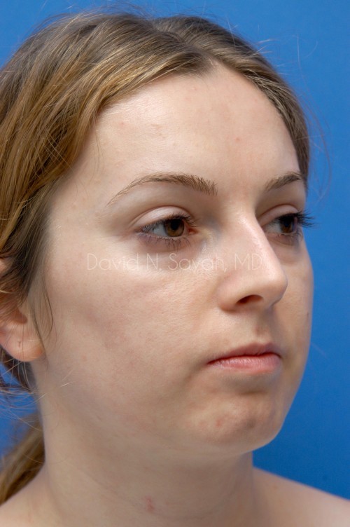 Fat Injection Face Before and After | Sayah Institute