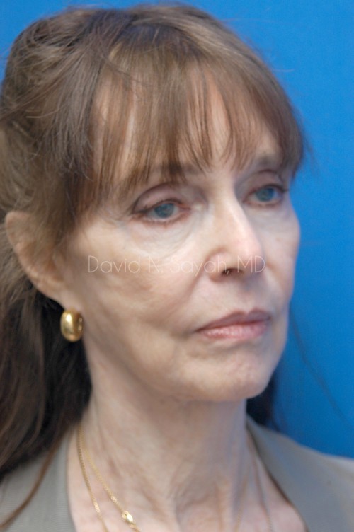 Fat Injection Face Before and After | Sayah Institute