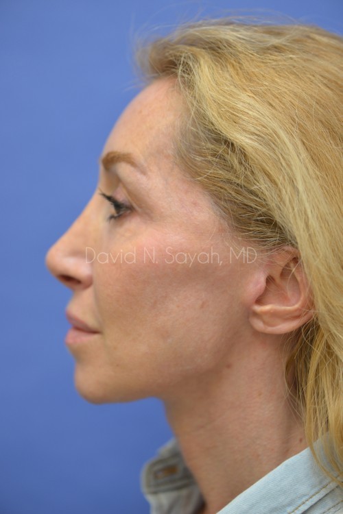 Fat Injection Face Before and After | Sayah Institute