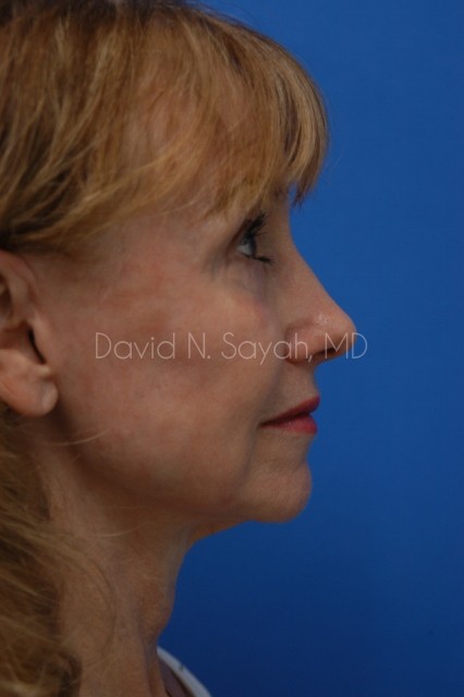 Fat Injection Face Before and After | Sayah Institute