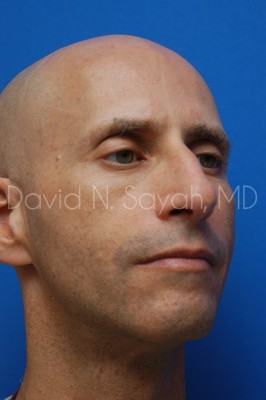 Fat Injection Face Before and After | Sayah Institute