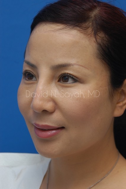 Fat Injection Face Before and After | Sayah Institute