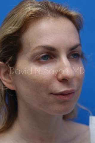Fat Injection Face Before and After | Sayah Institute
