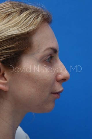 Fat Injection Face Before and After | Sayah Institute