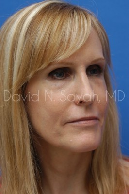 Fat Injection Face Before and After | Sayah Institute