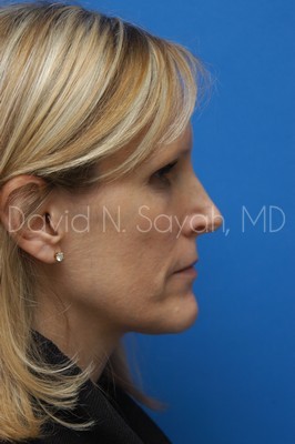 Fat Injection Face Before and After | Sayah Institute