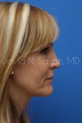Fat Injection Face Before and After | Sayah Institute