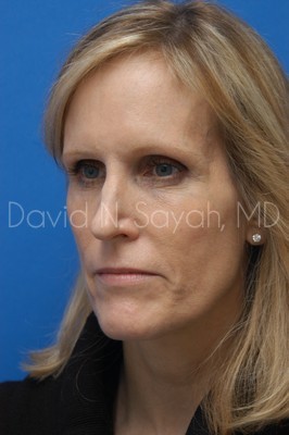 Fat Injection Face Before and After | Sayah Institute