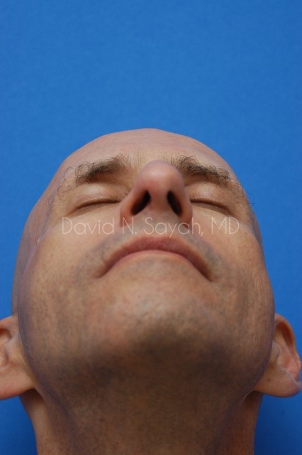 Fat Injection Face Before and After | Sayah Institute