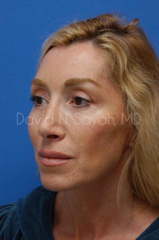 Fat Injection Face Before and After | Sayah Institute